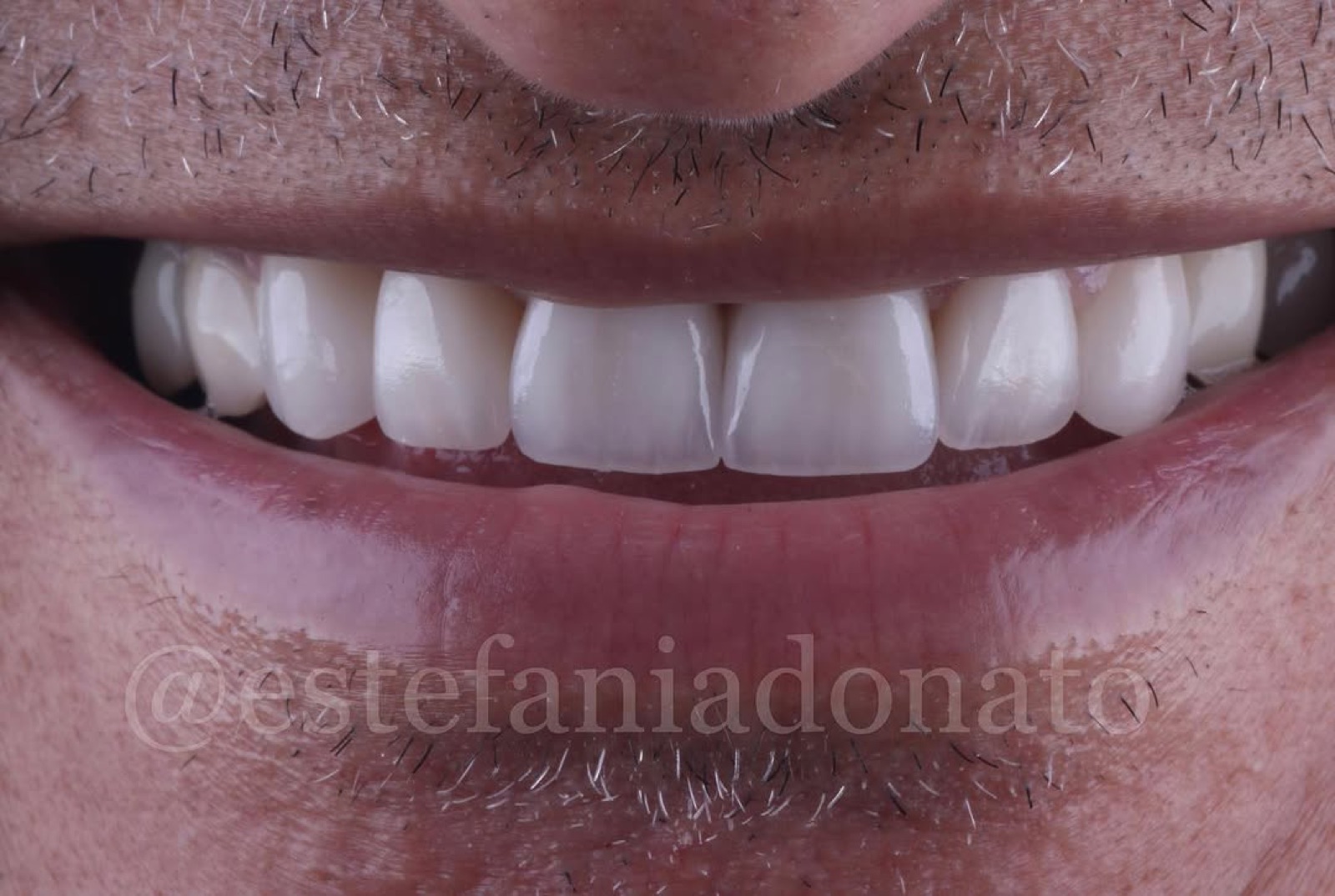 Caso de reabilita&ccedil;&atilde;o oral com lentes e coroas