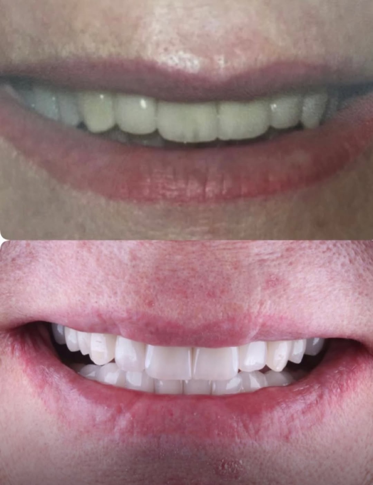 Caso de facetas em porcelana