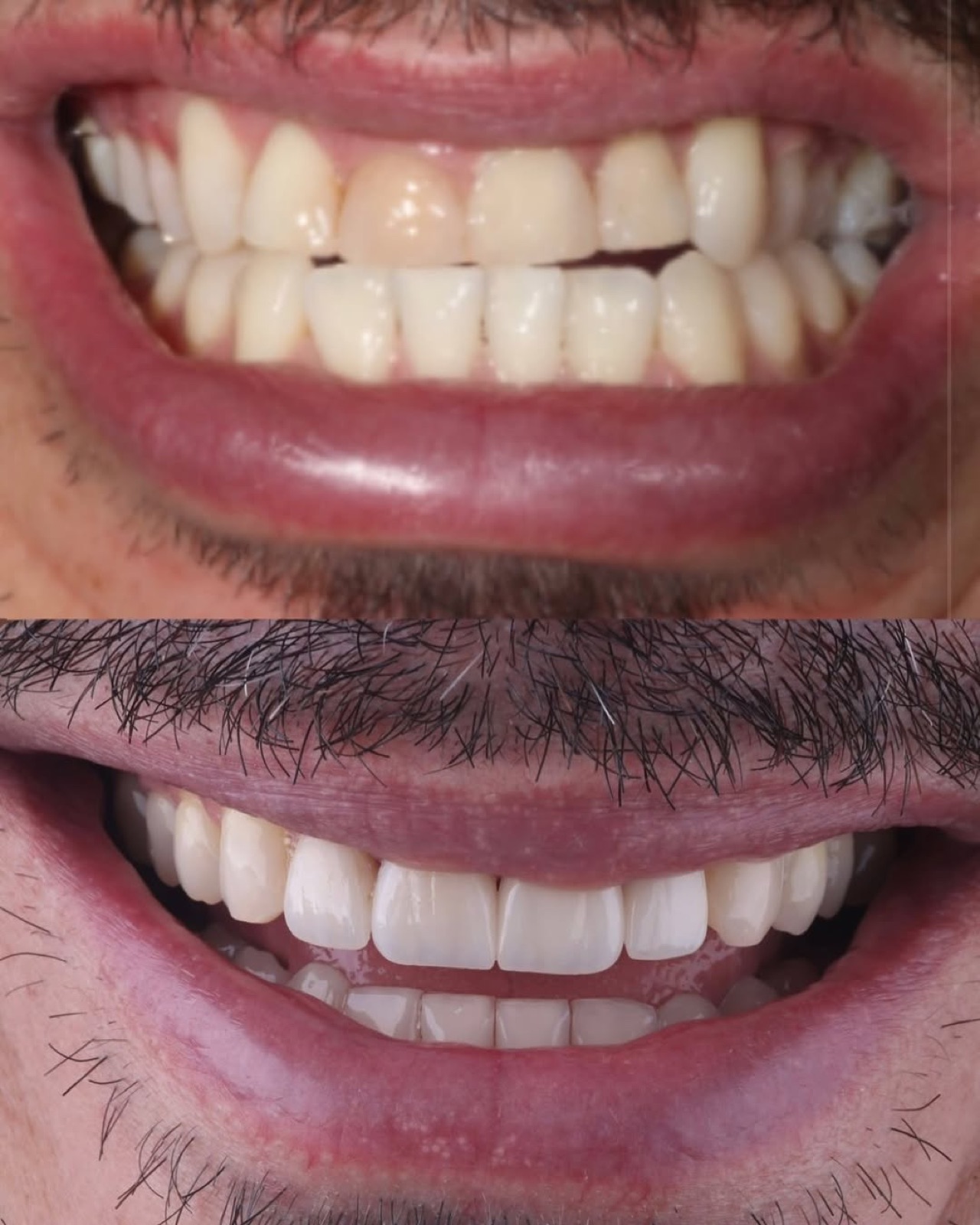 Caso de Invisalign e facetas