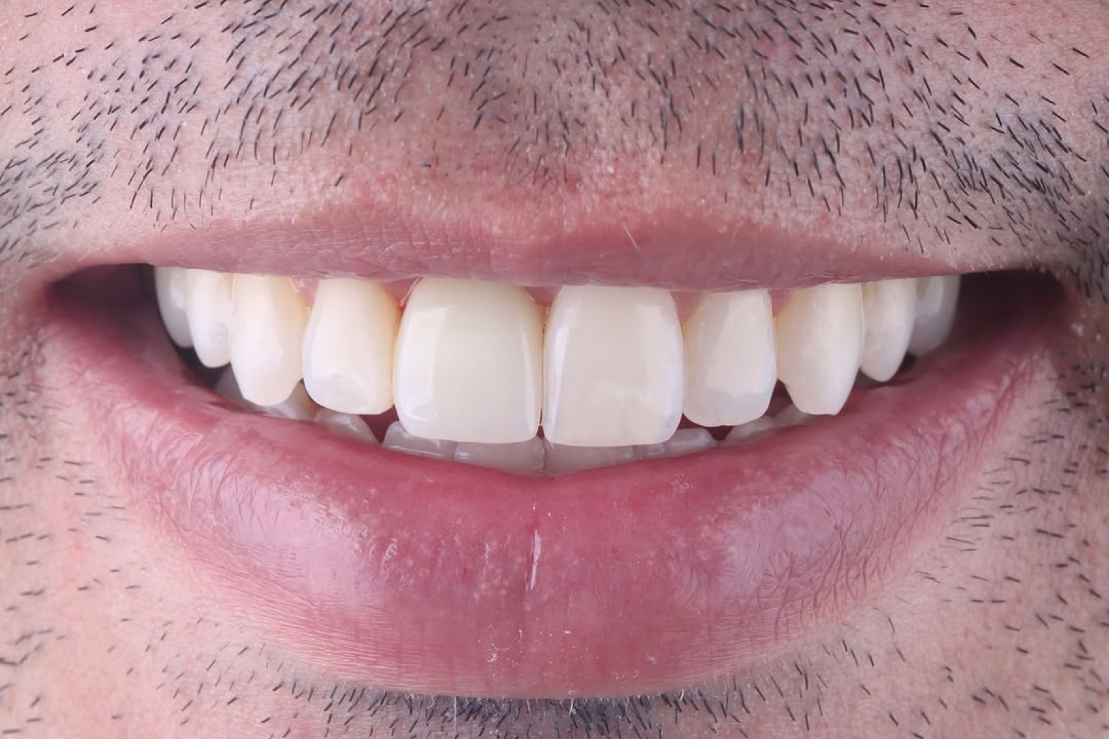 Caso de Invisalign e implante